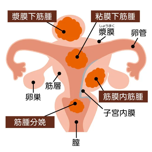 子宮筋腫