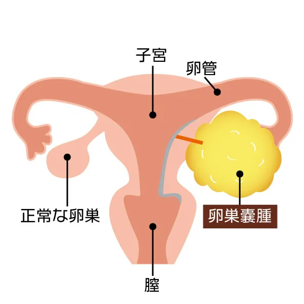 卵巣嚢腫