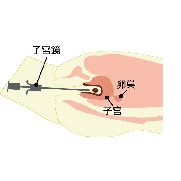 子宮鏡下手術