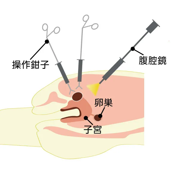 腹腔鏡下手術