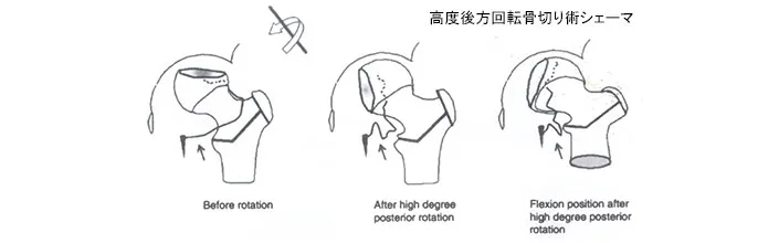 高度後方回転骨切り術シェーマ