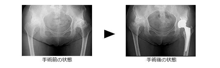 通常の人工股関節