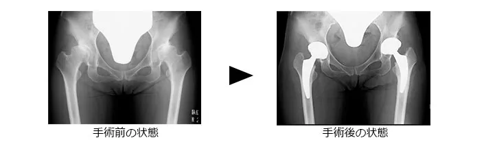 若年者に最小侵襲で行った、骨温存の人工股関節
