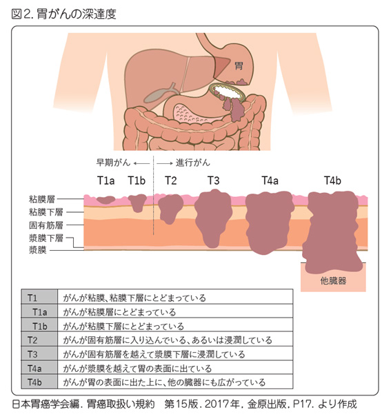 胃がん