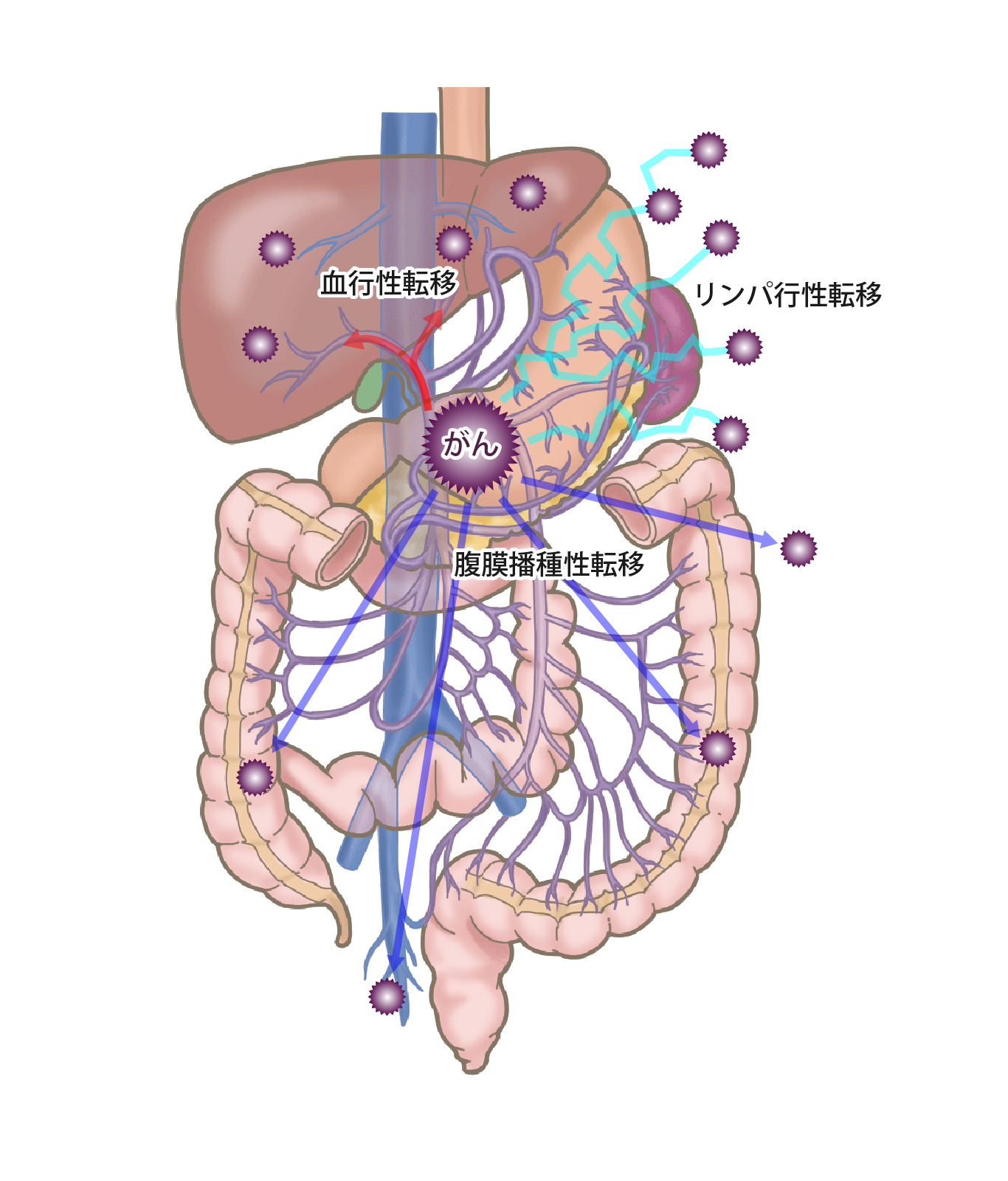 胃がん　リンパ行性転移　血行性転移　腹膜播種性転移